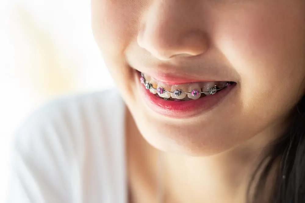  Close-up of a person smiling and showing metallic braces with Colored Brace Bands Anna on their teeth. The lower half of the face is visible, and they are wearing a white shirt in this vibrant TX moment.