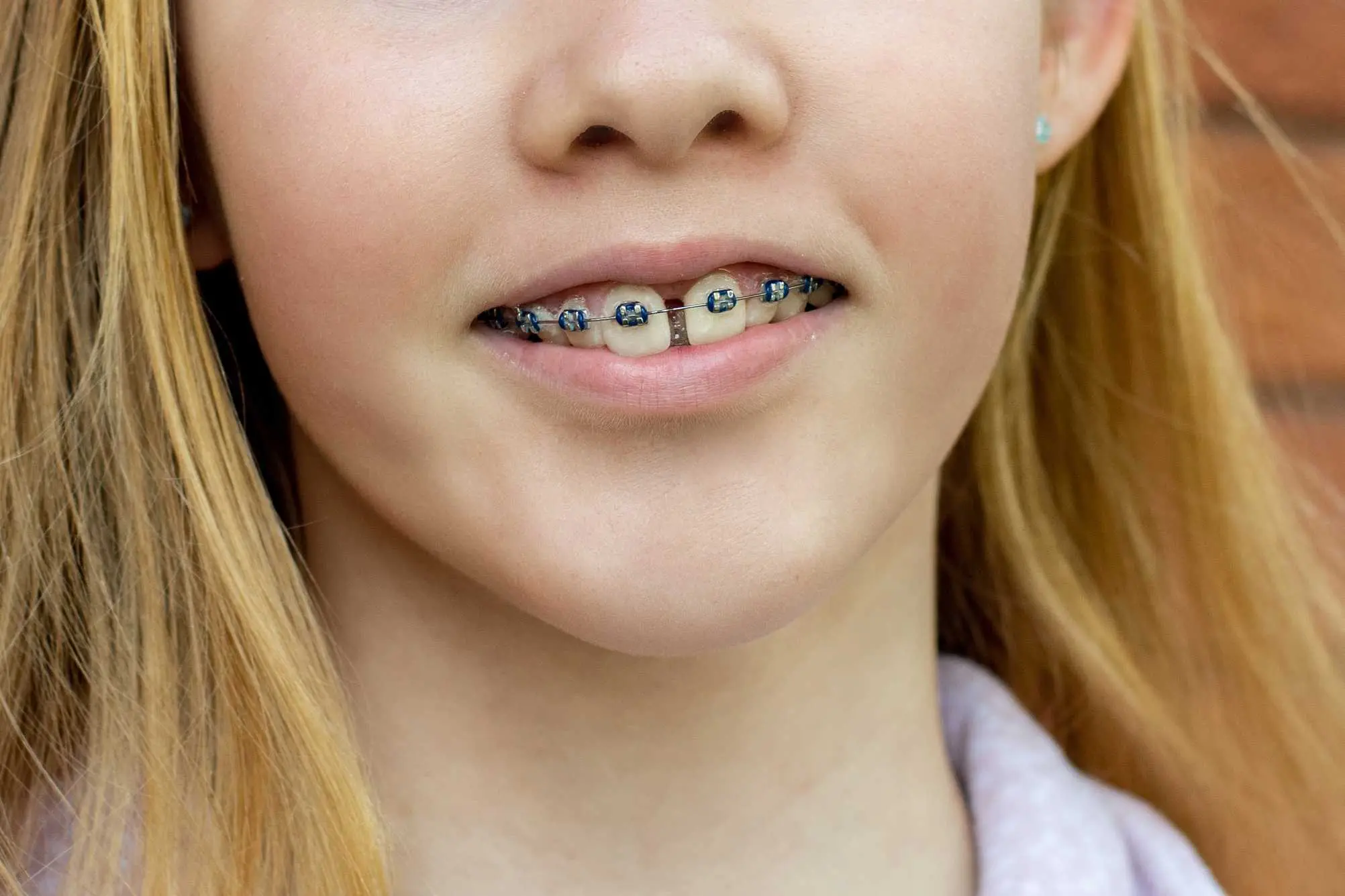 young girl wearing a metal braces