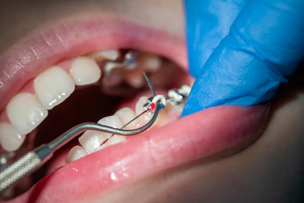 A close-up of a dentist adjusting braces on a patient’s teeth using dental tools, with the dentist wearing blue gloves.