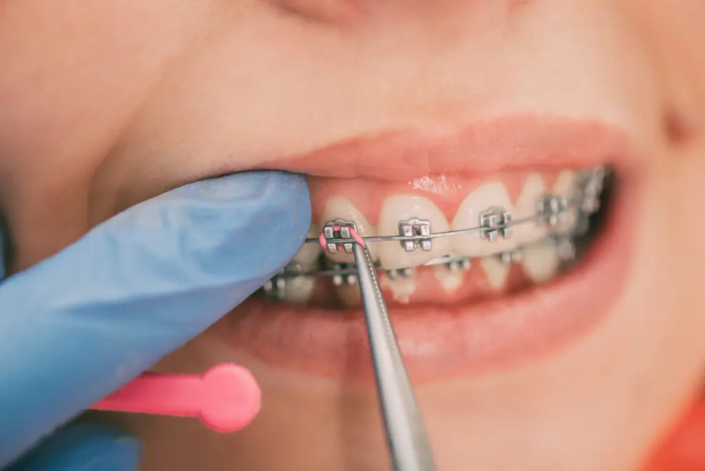 Orthodontic tool adjusting metal braces on a patient's teeth