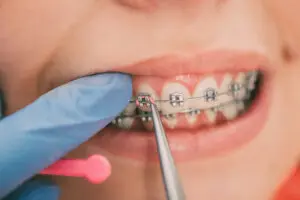 Orthodontic tool adjusting metal braces on a patient's teeth