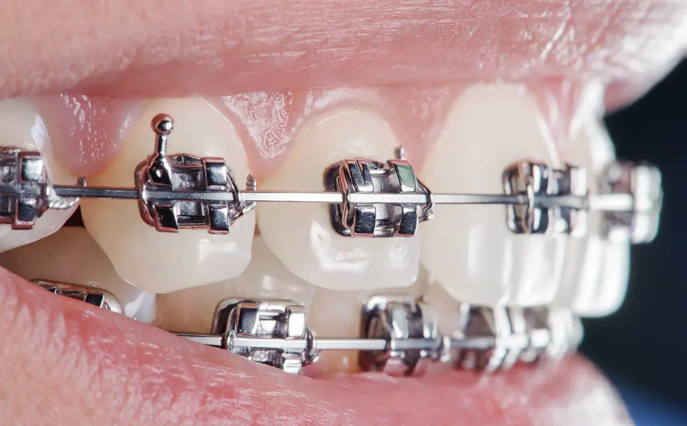 Close-up of a person's teeth with metal braces in Santa Rosa, highlighting the brackets, wire, and an orthodontic hook attached to the upper teeth.