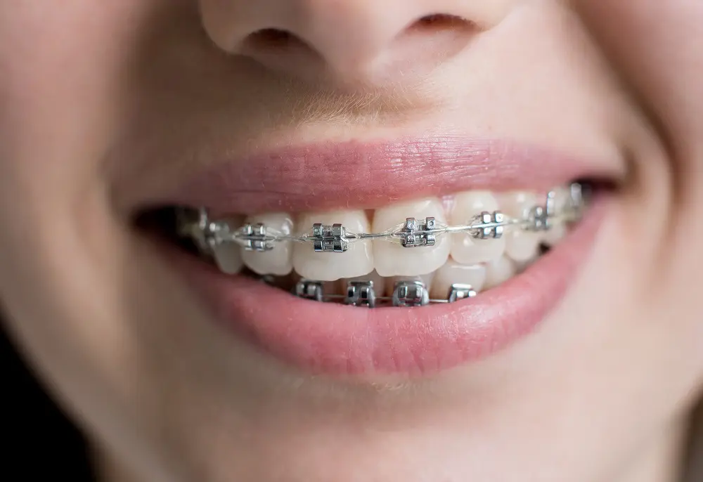 Close-up of a person smiling, showing teeth with metal braces on both the upper and lower rows—an example of braces in Sacramento.