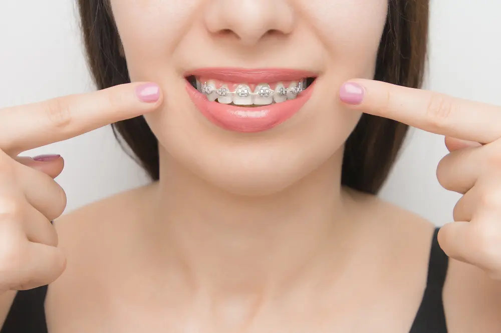 A person smiling and pointing at their teeth with metal braces, showcasing their new braces in Sacramento.