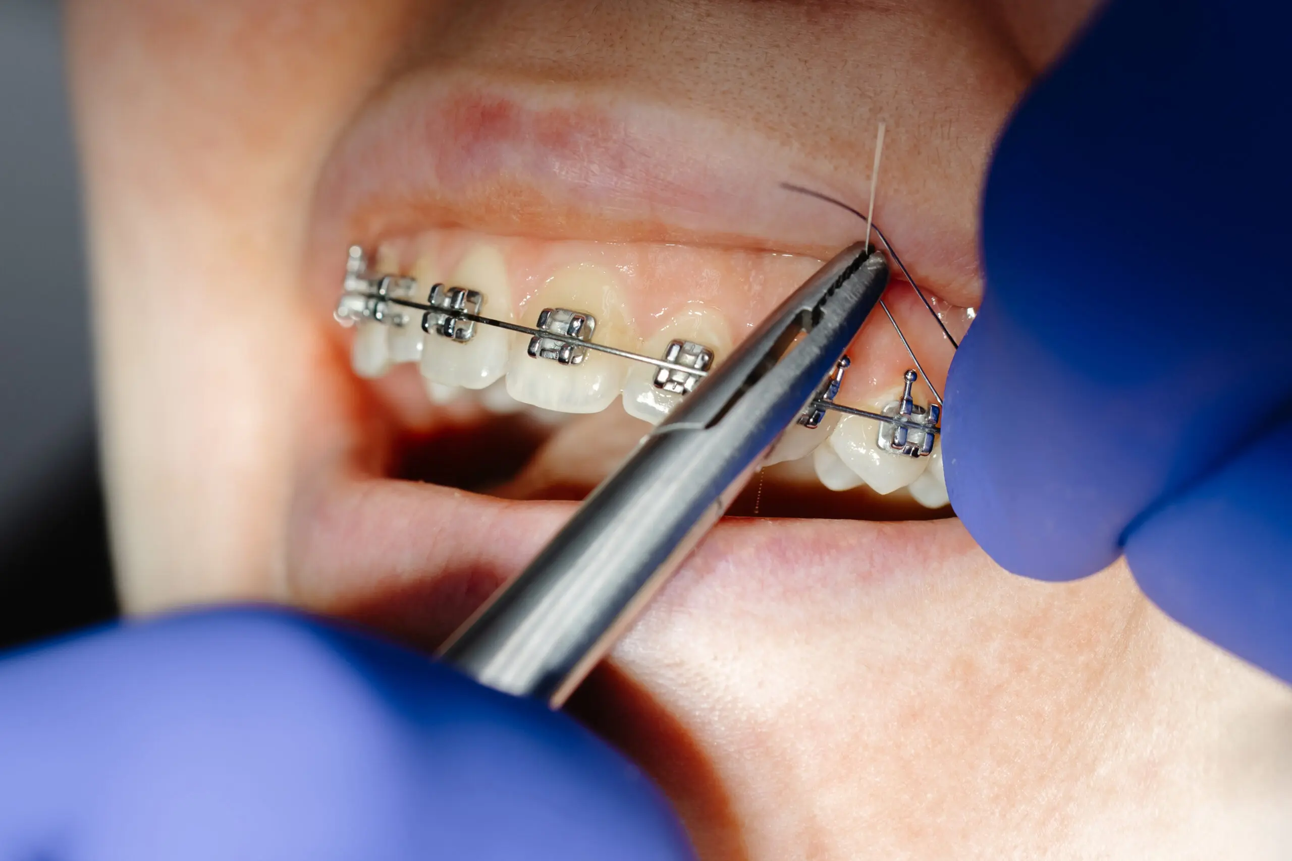 Close-up of a dentist working on a patient's teeth, installing braces using specialized pliers and wires