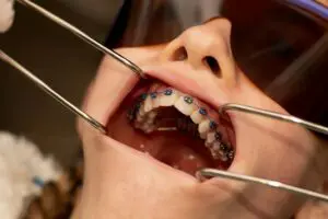 Close-up of metal braces during an orthodontic adjustment