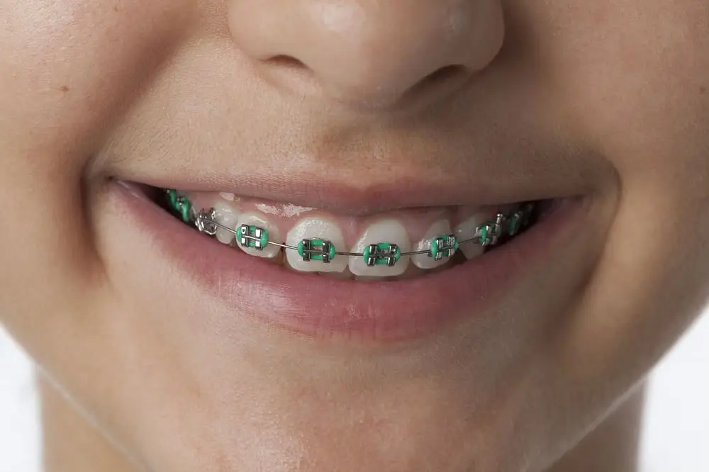 Close up of dental braces in the mouth and on the teeth of a teenage girl