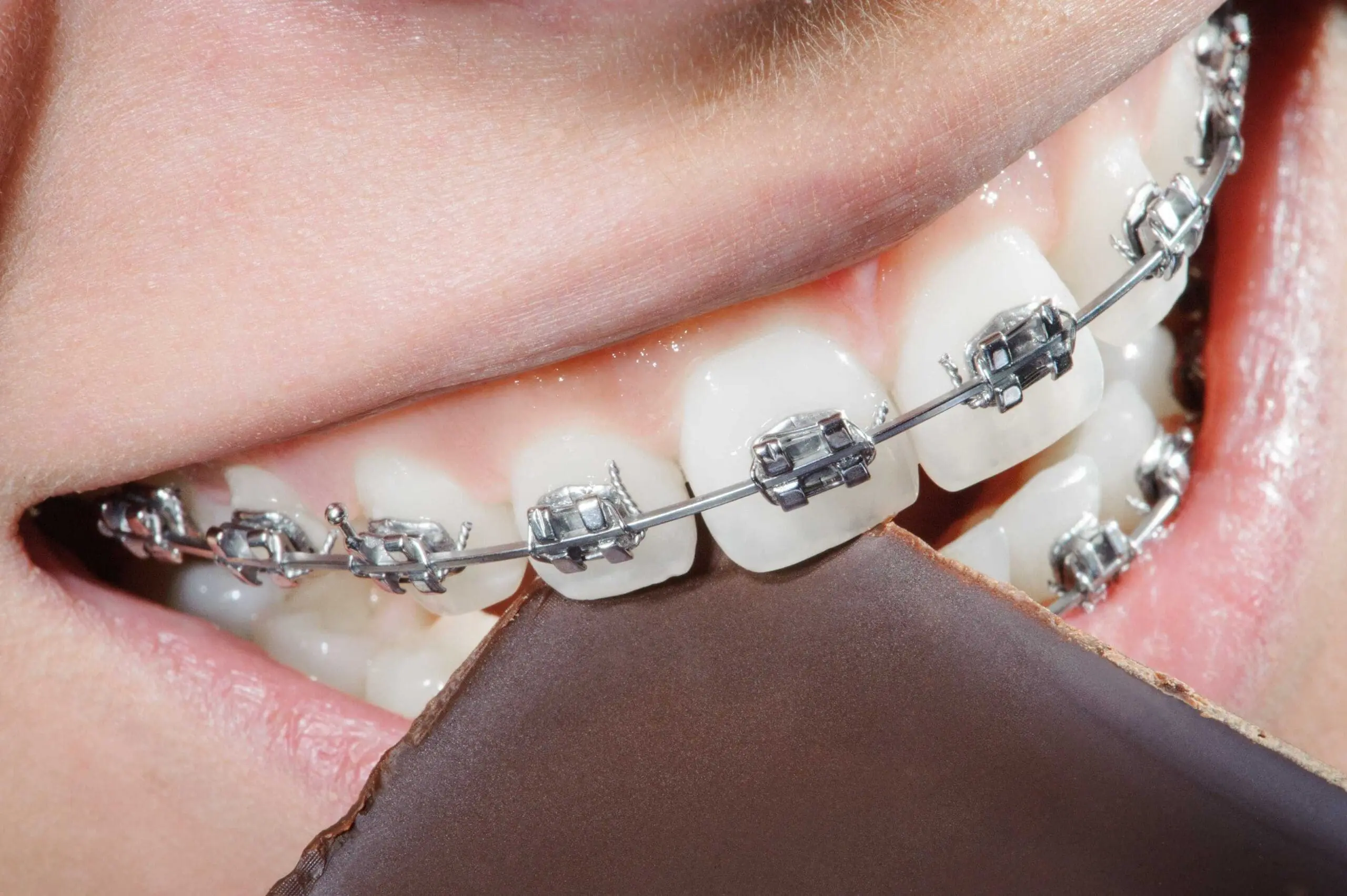 close up smiling with metal braces eating chocolates