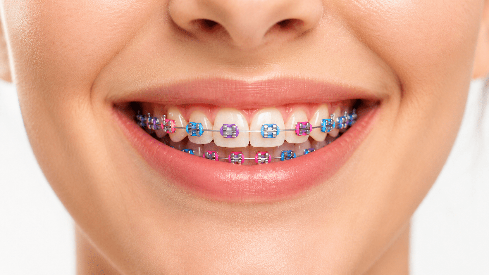 Braces and bright smiles