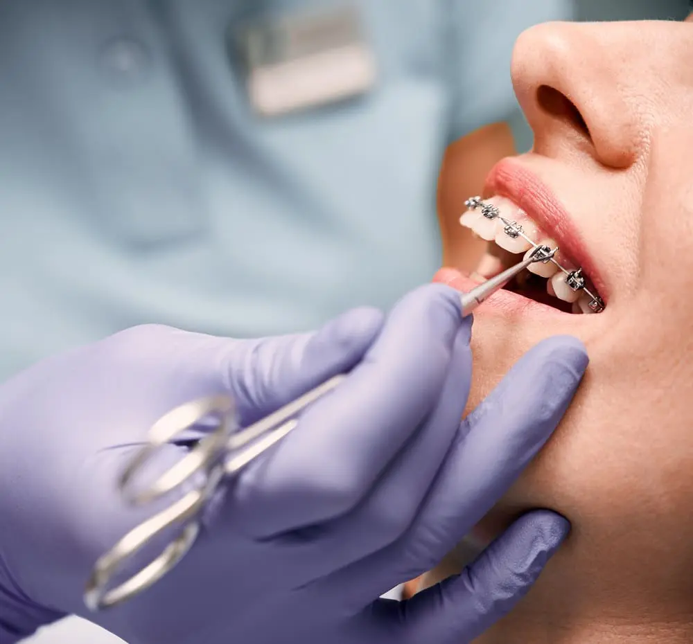 Close up of dentist hand using dental forceps while putting orthodontic braces on female patient teeth. Woman with metal braces having dental procedure in clinic. Concept of orthodontic treatment.