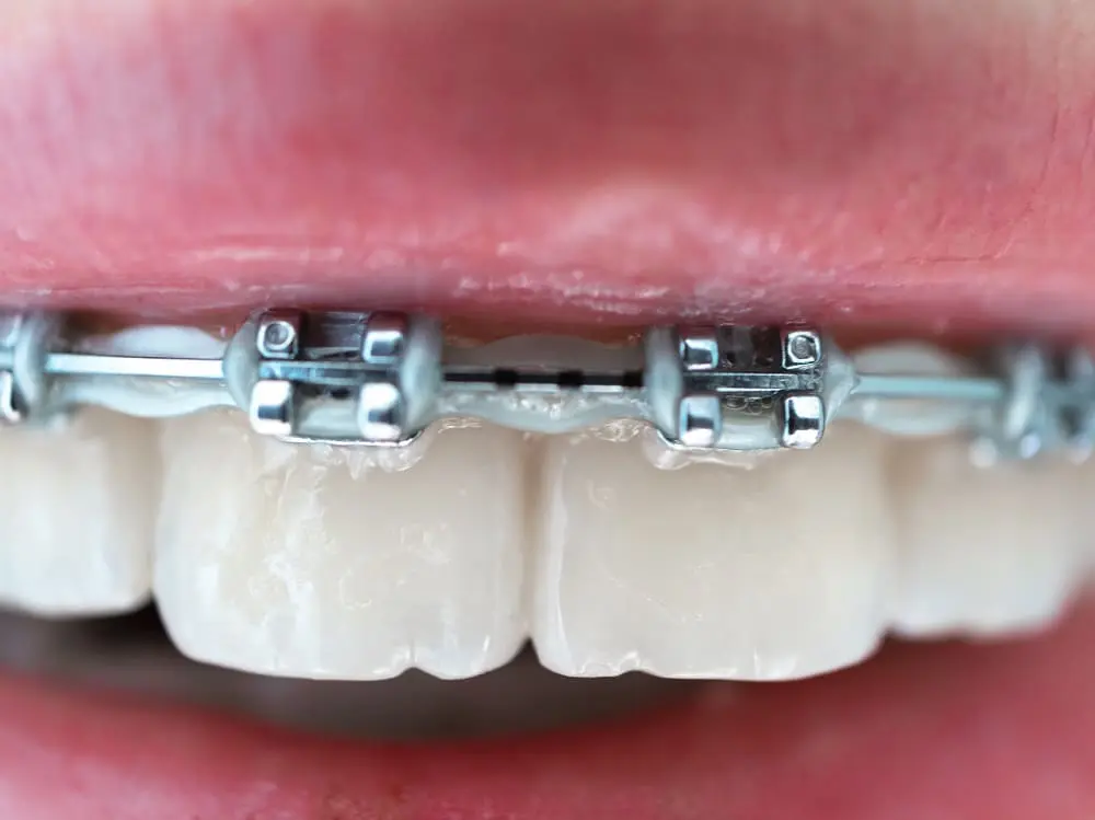 Close-up metal bracket system. Orthodontic treatment macro