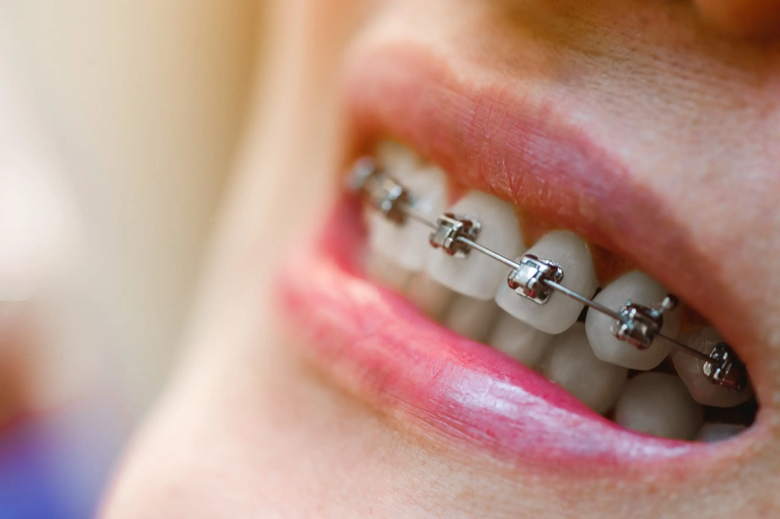 close up of a perfect metal braces