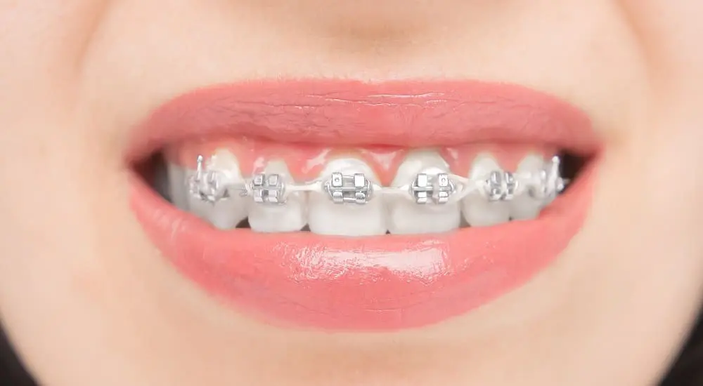 Close up to dental braces. Brackets on the teeth after whitening. Self-ligating brackets with metal ties and gray elastics or rubber bands