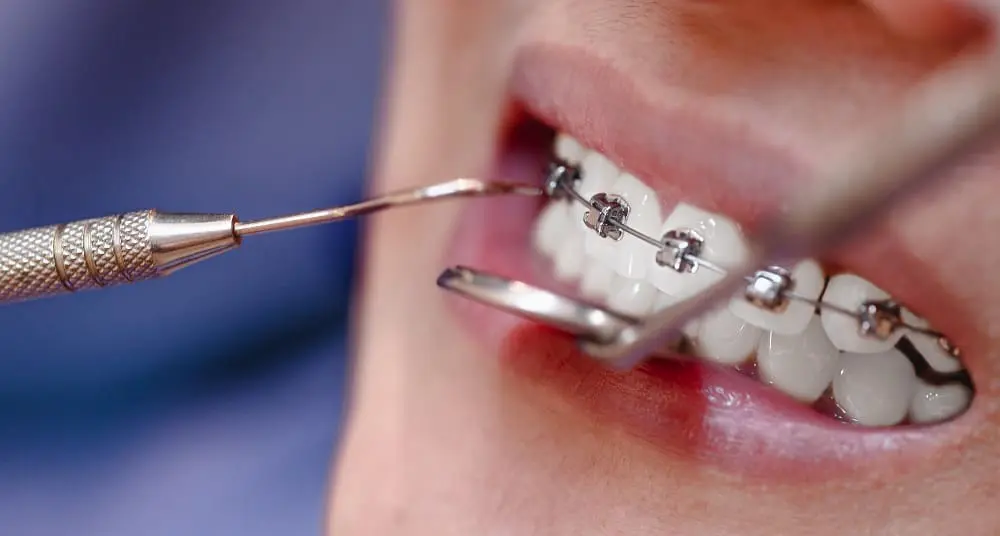 Dentists check the teeth and braces the patients in the clinic for better dental health and a bright smile.
