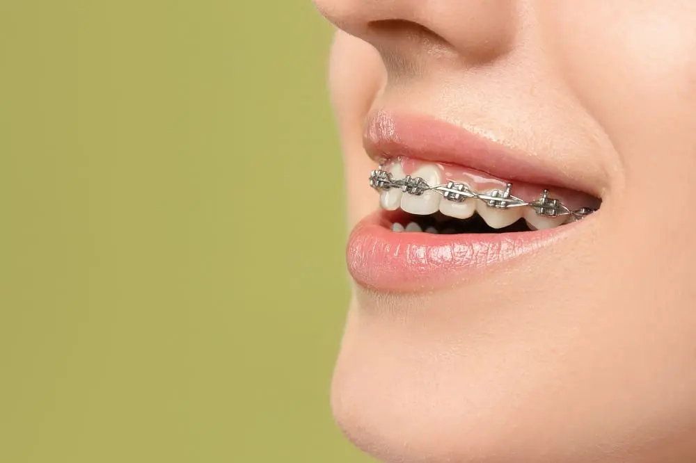 Smiling woman with dental braces on light green background, closeup. Space for text