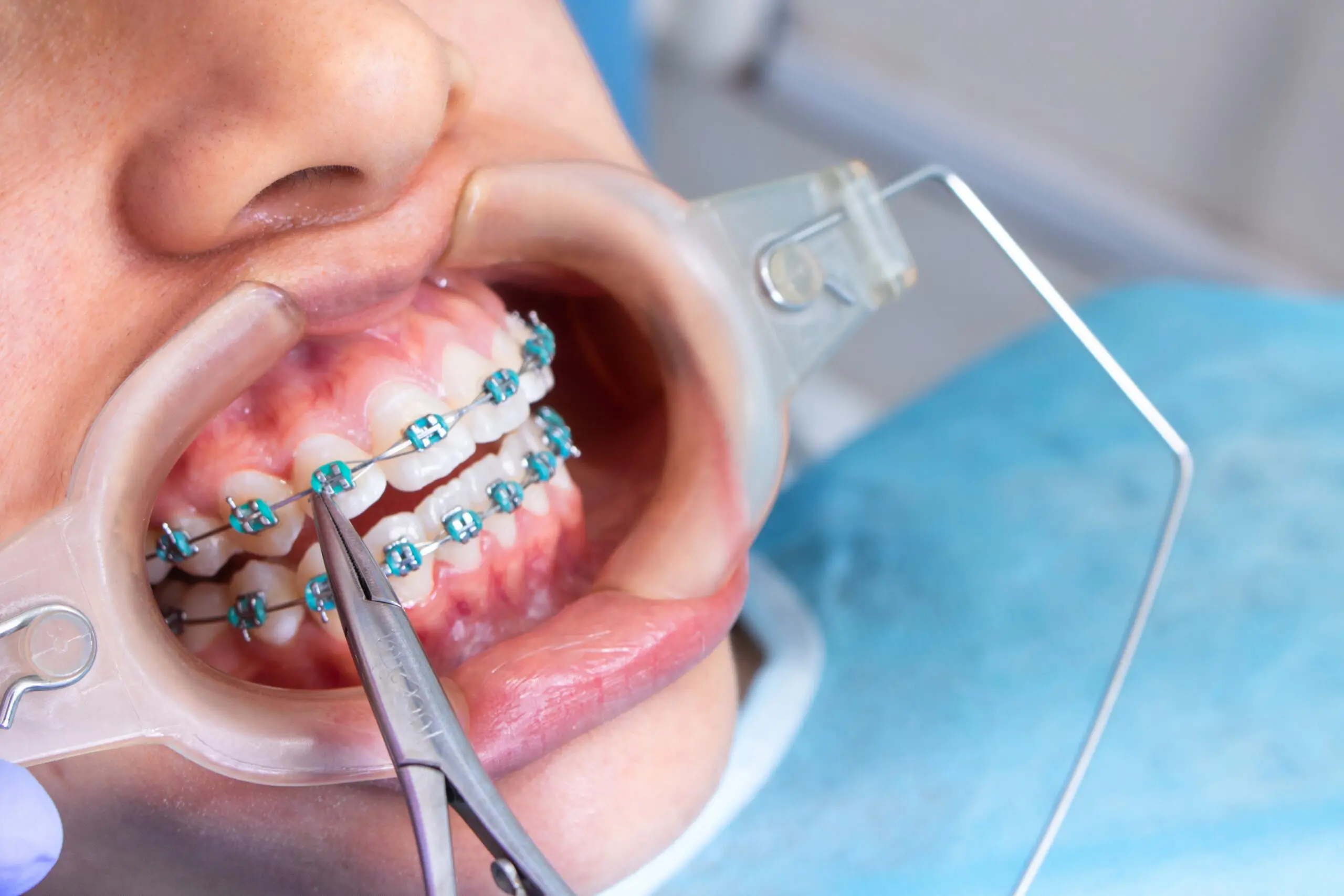 braces being adjusted placing colored bands