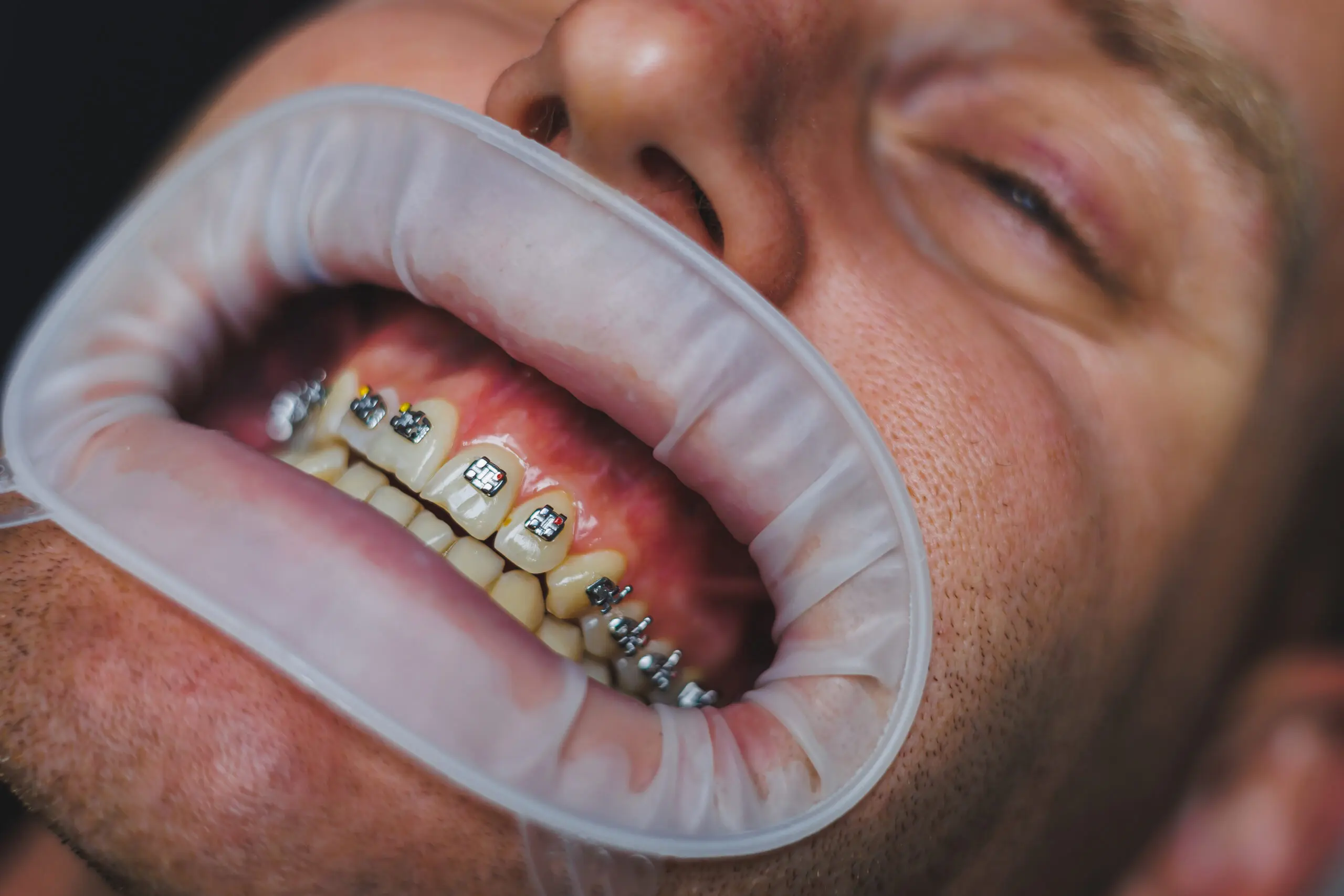 Dental treatment of teeth. A young man at a dentist's appointment. The doctor installs metal braces on the teeth. Close-up of teeth with braces