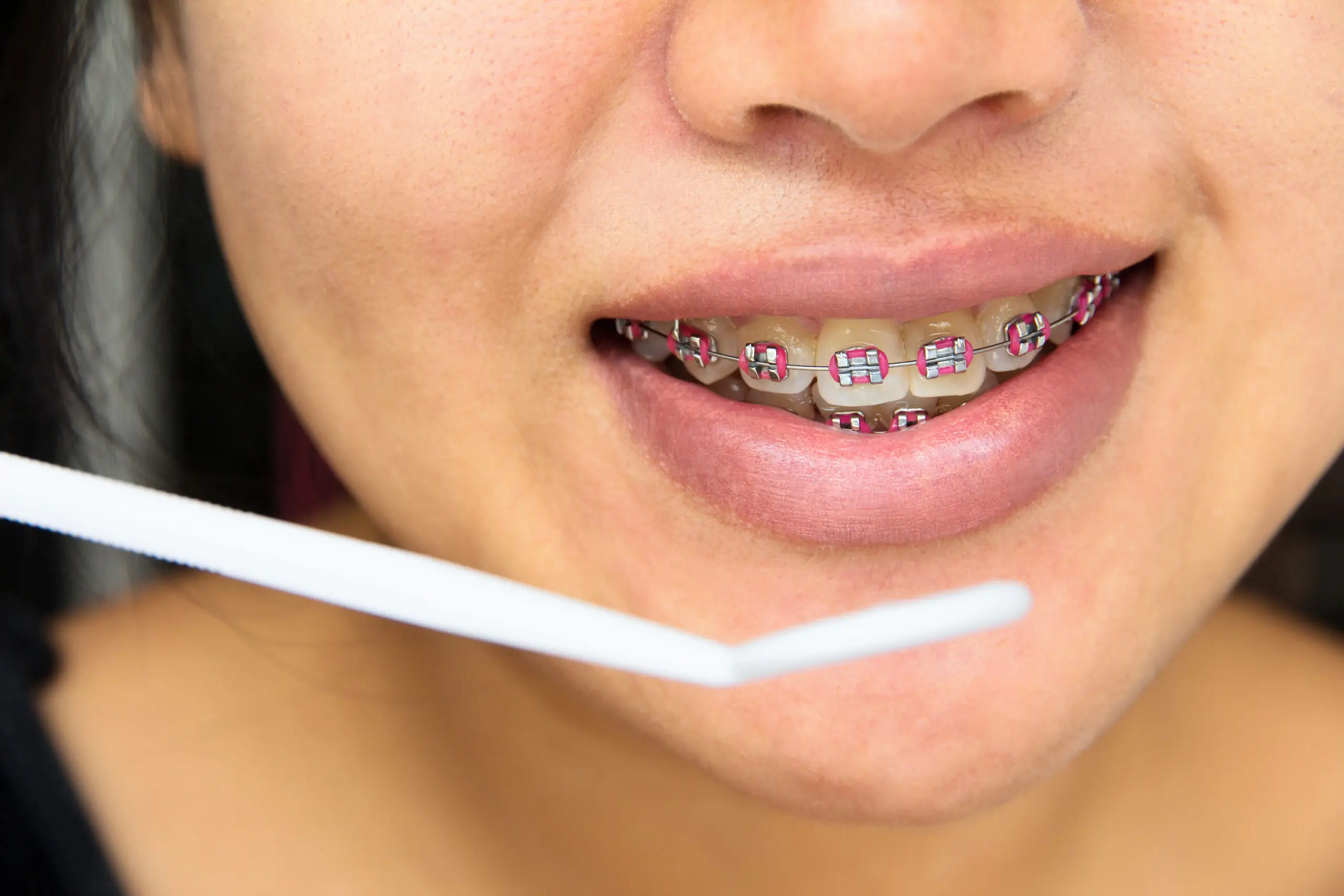 close-up-of-teeth-with-pink-braces-2026-01-08-21-57-58-utc