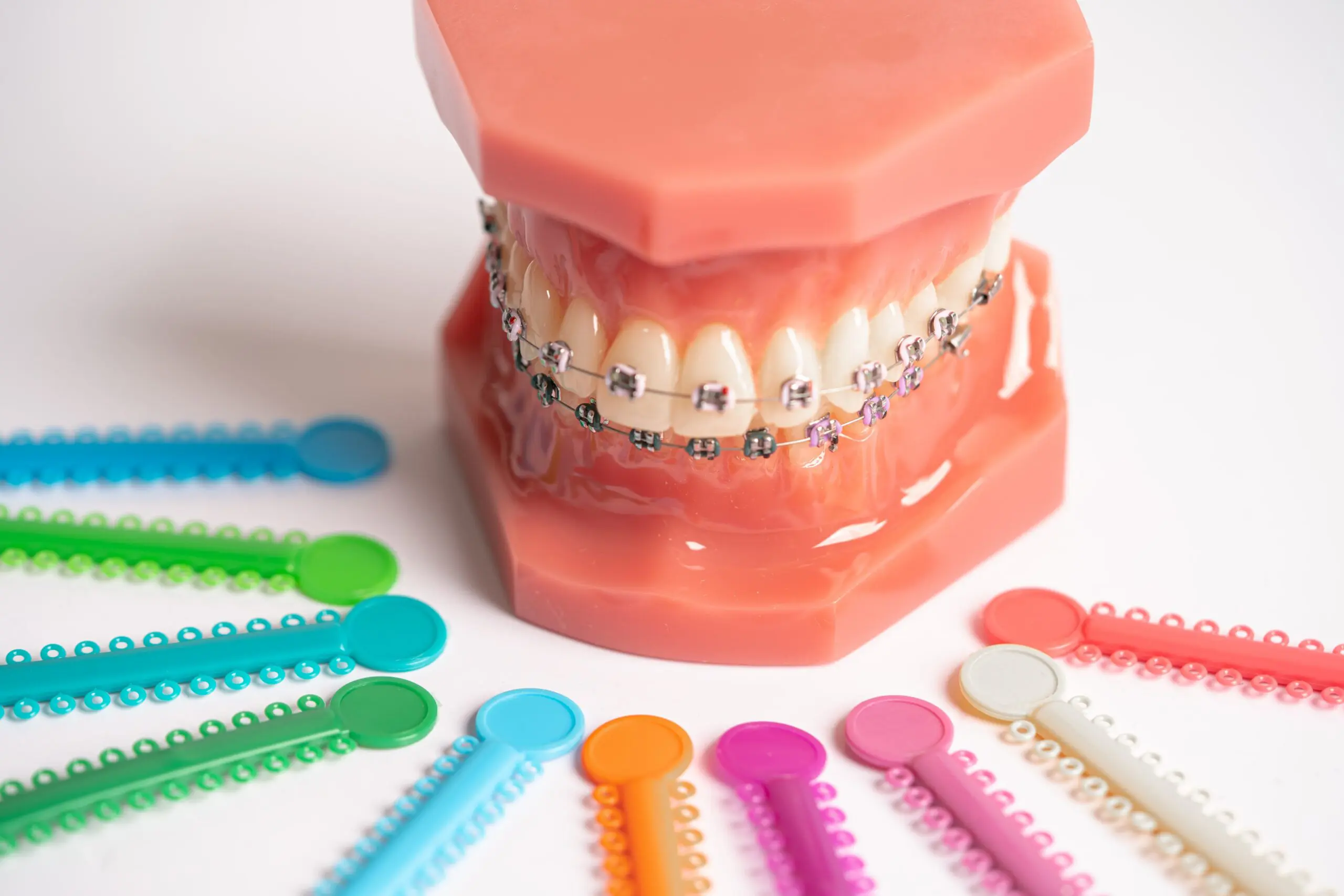 colored bands for braces