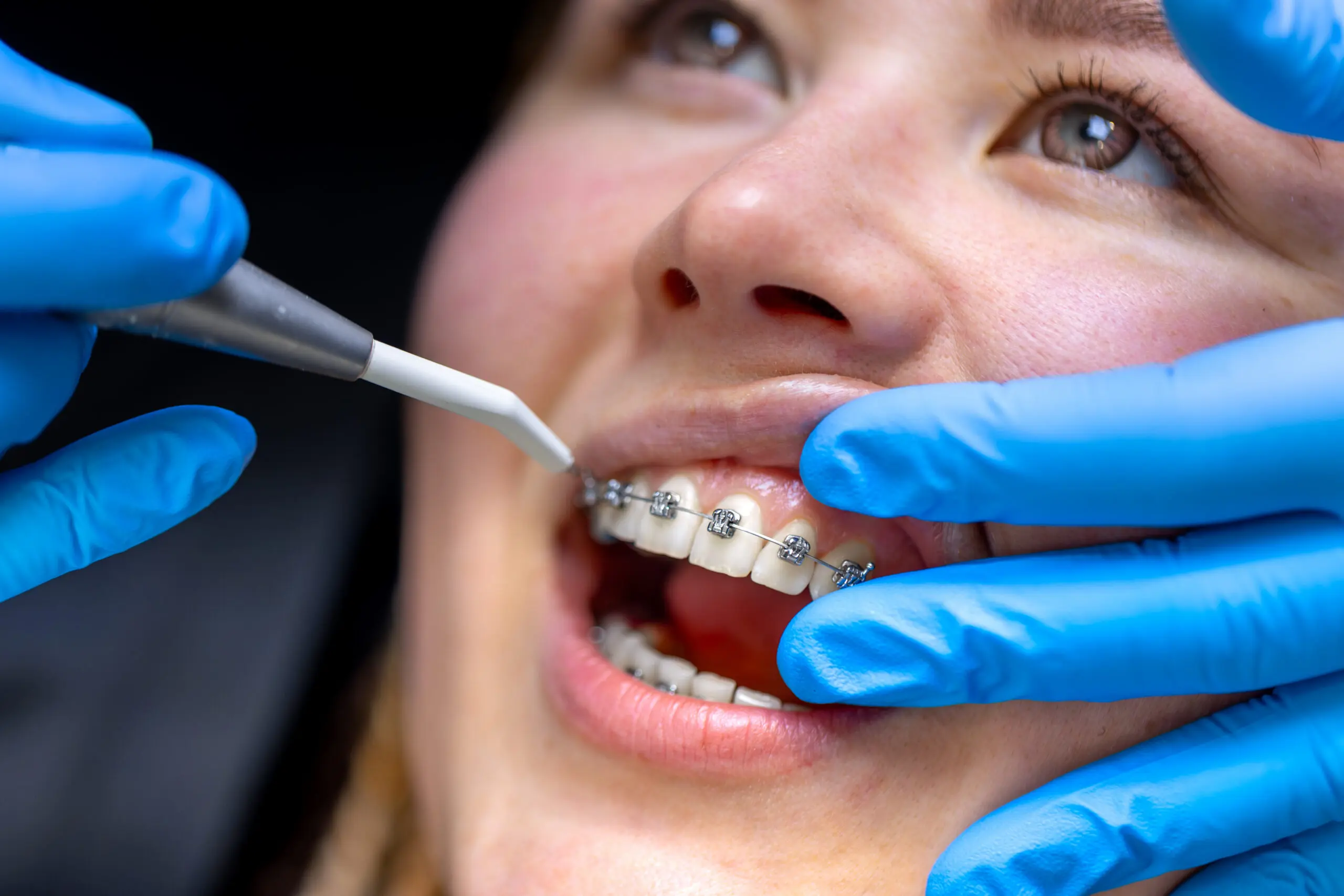Dental procedure for installing braces close up. Dentistry. Braces on the teeth. High quality photo. Professional dental treatment. Doctor and patient. SSUCv3H4sIAAAAAAAAA41Py46DMAz8F5+DZF6l5FeqHgJxqVUgVeK0WqH8+yqUaq97m7E9D2/AFjR0QztSX2GBLTZFWd6wON/Kvmi6pqsqwlNbIyiwRgh0Wdfnrsaqb/tT3yIiKhhM4BH0BjzPMYg3wm4FjQo8rZb8DsmyOM9mBo1JQRAjMVAAvSUFoxGanOedf/0uW56DBlAQ4pBBUv+cXRWYidbxJ/unXGQms8ddrgoebyG/HNlO7rlihk/PI6/T0SkGccsHr06ydk8QNz7YHuLPG3cO4nzOgvicnbFkj3UcFhb5Uk8vpvffdUrpF0r5PteEAQAA