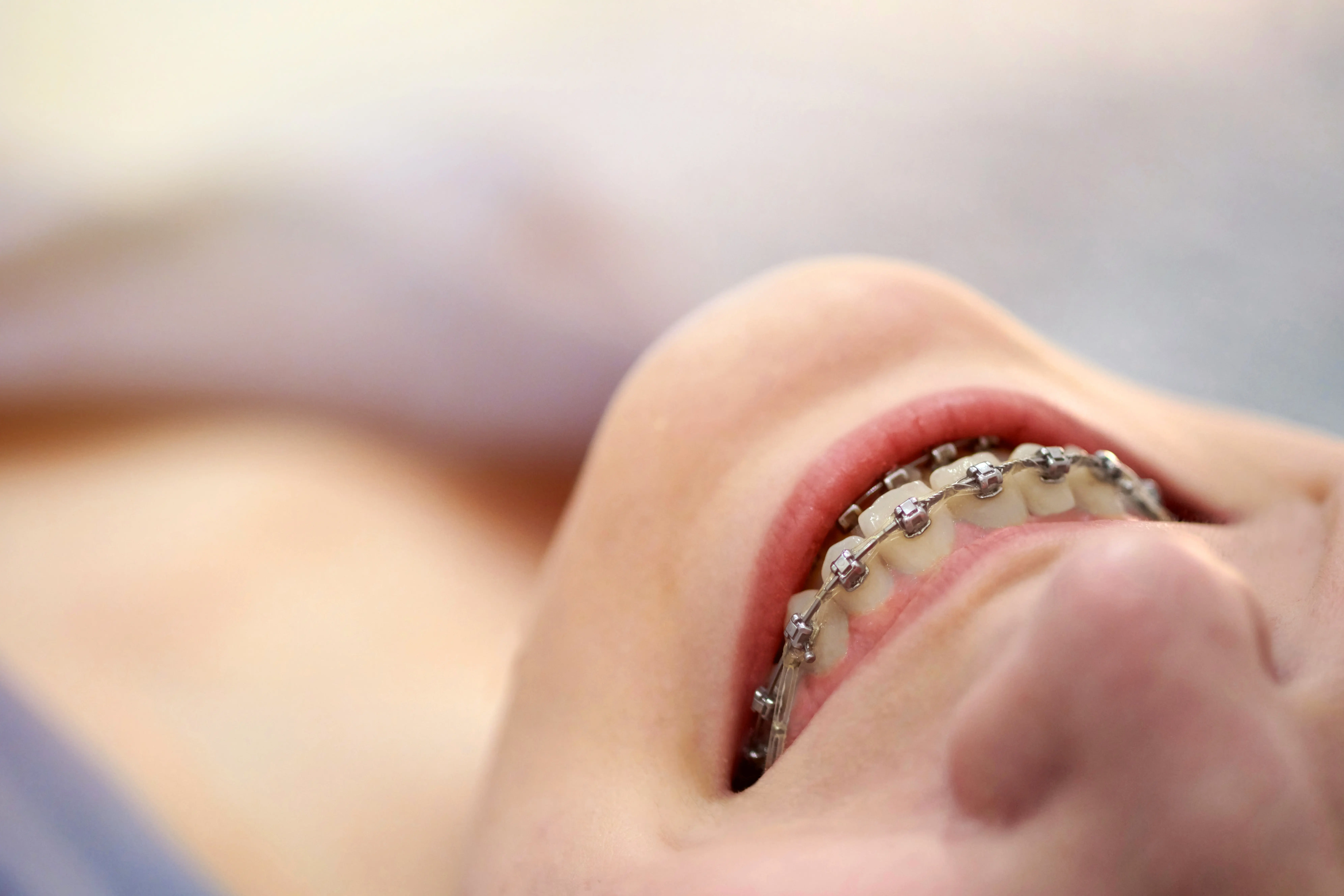 Smiling young woman with brackets on teeth close up. Metal self-ligating dental braces.