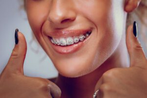 Close view of smiling woman with braces on teeth - Smilebliss Orthodontics