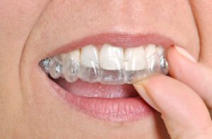 Invisible Braces - Smilebliss Orthodontics