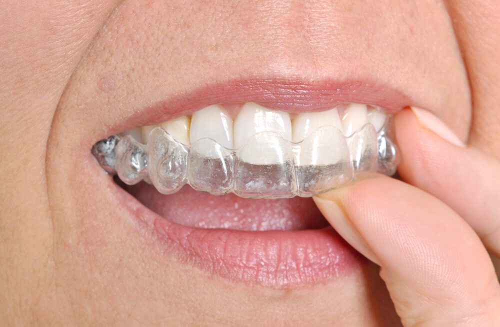 Invisible Braces - Smilebliss Orthodontics