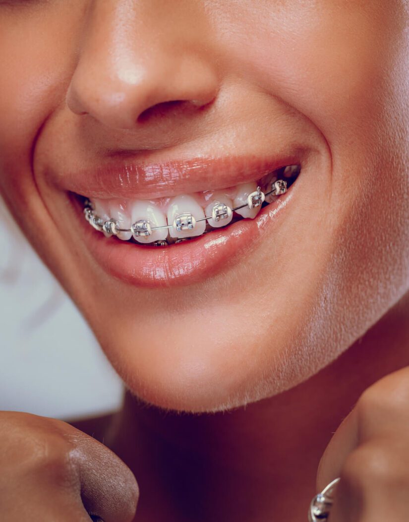 Close view of smiling woman with braces on teeth - Smilebliss Orthodontics
