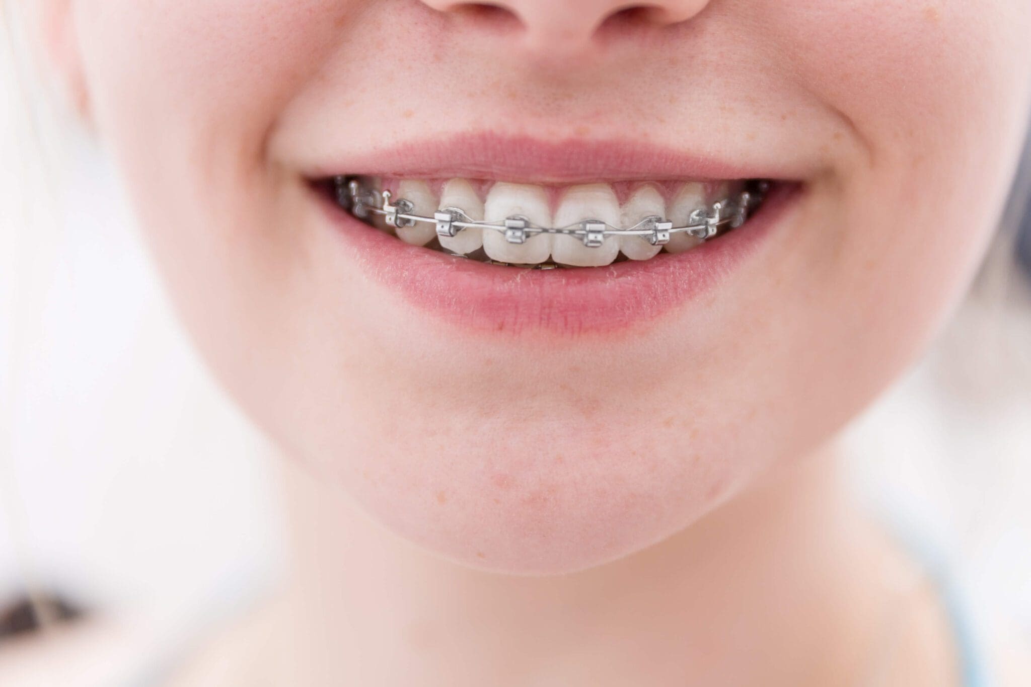 Braces in Kissimmee, FL | Smilebliss Orthodontics