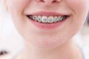 Dental brace in Kissimme - Smilebliss Orthodontics