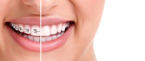 Healthy smile with braces - Smilebliss Orthodontics