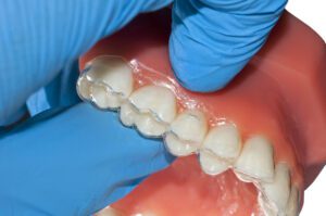 dentist hand show invisible braces orthodontic removable aligner