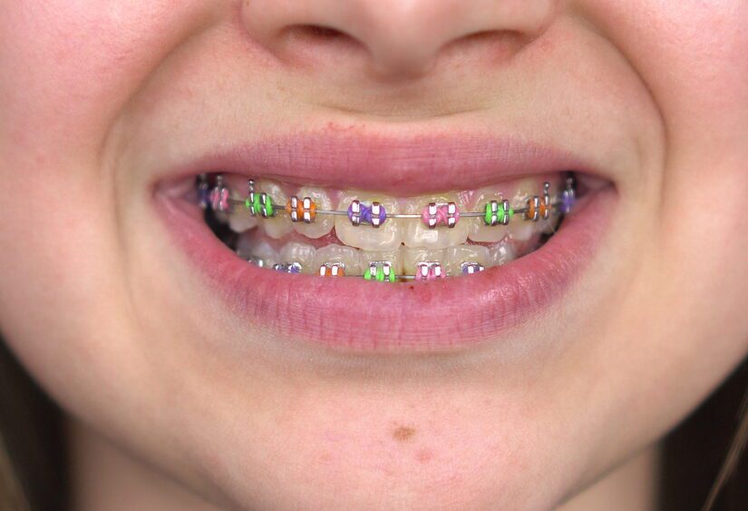 Teen girl with braces smiling close-up. Girl with colored braces on her teeth.