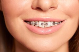 Closeup of woman teeth with braces. High quality photo