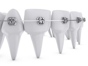 metal dental brackets mounted on the teeth