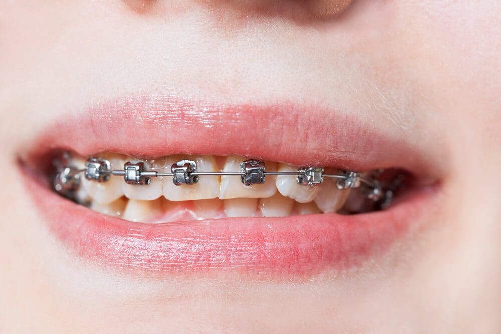 Different Types of Braces Smilebliss