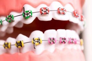 Dental Metal Braces with colored bands