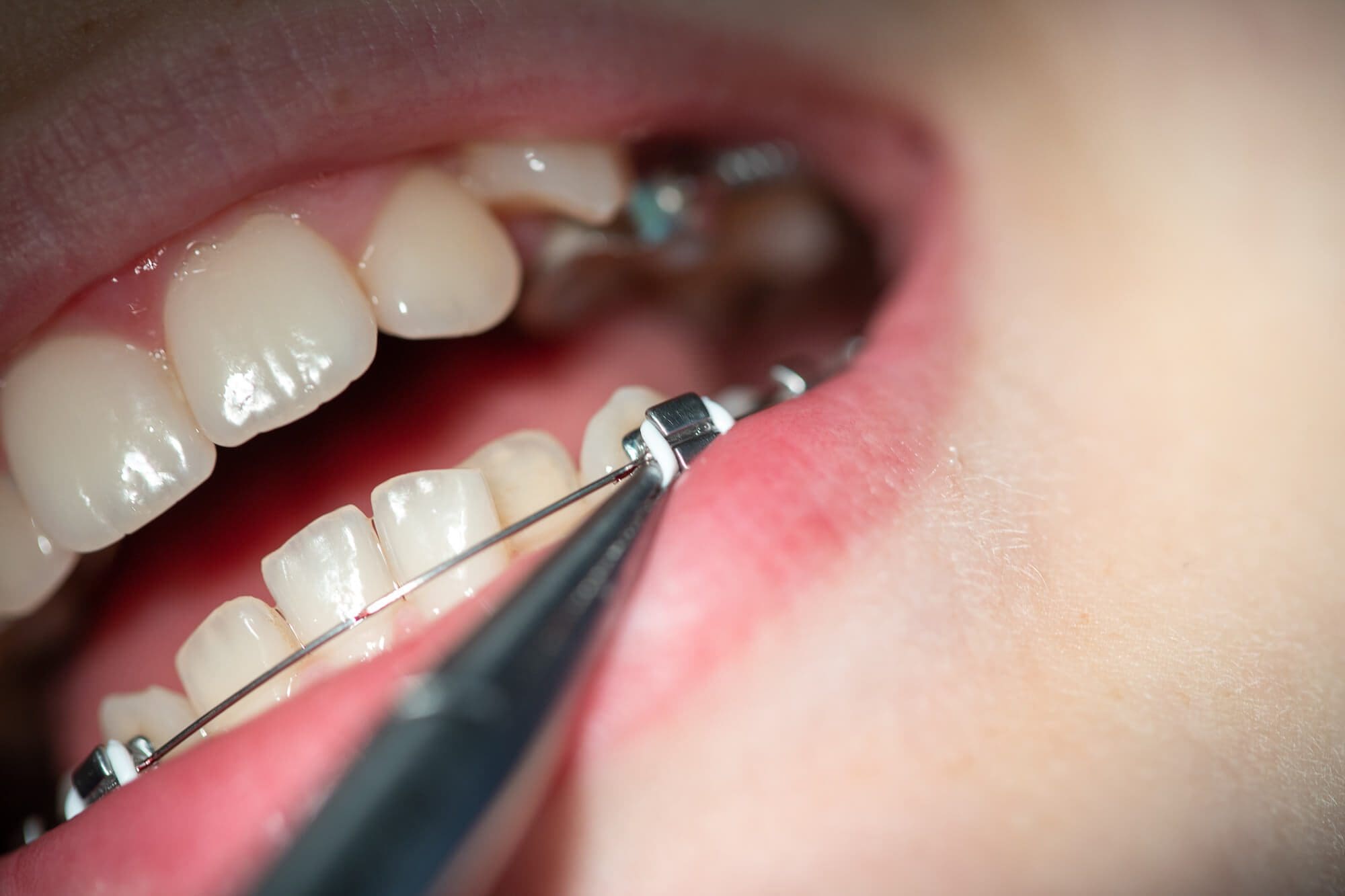 Different Phases of Braces Treatment Smilebliss