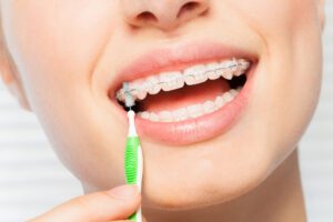 Close-up picture of woman using interdental brush for self ligating braces