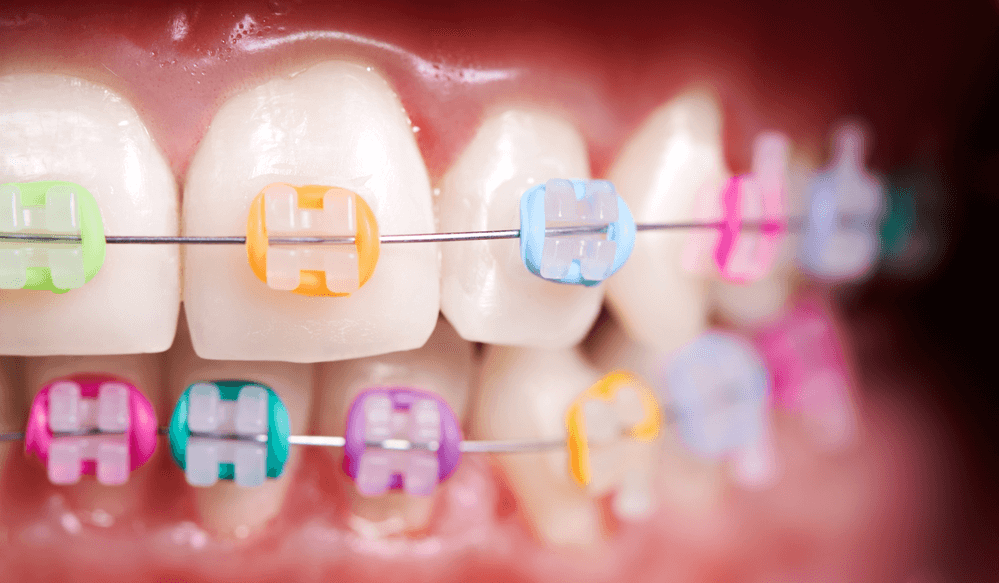 Colored Bands for Braces-Smilebliss
