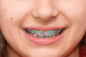 Colored Bands for Braces in North Charleston