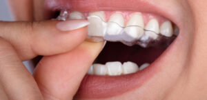 woman using clear aligners
