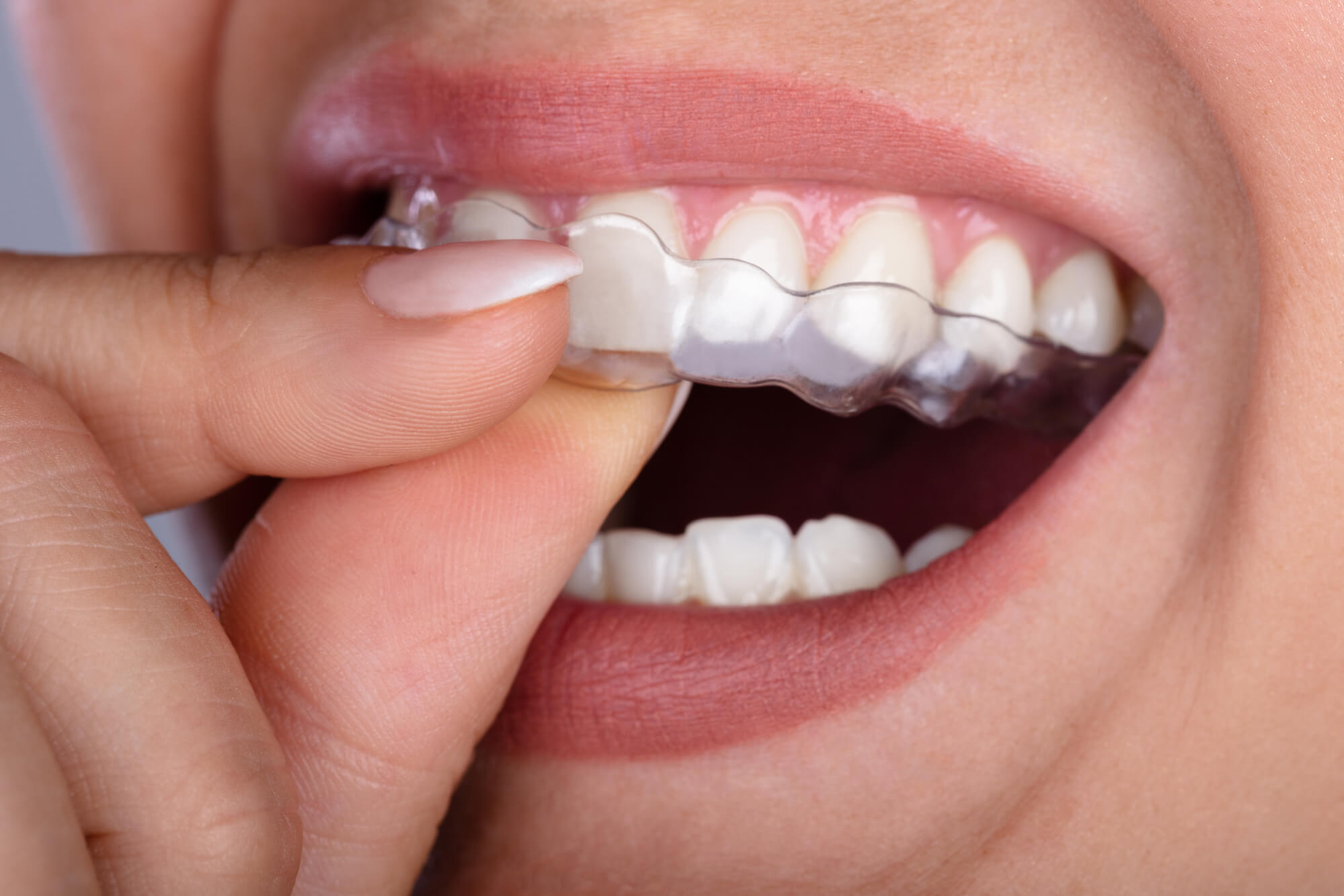 https://smilebliss.com/wp-content/uploads/2024/02/woman-using-clear-aligners.jpg
