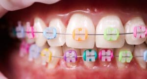 Macro snapshot of white teeth and ceramic braces with colorful rubber bands on them, latex cheek retractor on lips