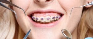 Closeup shot of dentist tools in front of smiling mouth with braces.