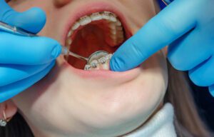 Teeth in a dental clinic, braces are installed