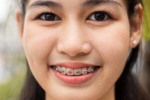 Young female beautiful smile with braces. Close up beautifying t