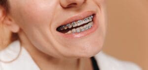 Close-up of a woman with braces on a beige background