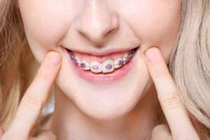 Closeup of a young woman pointing to her teeth with braces.